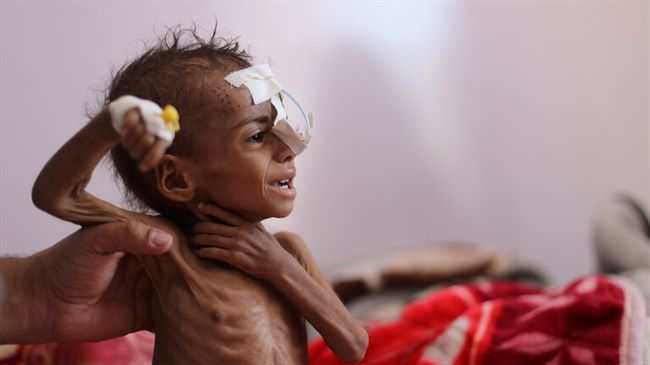 الامم المتحدة تحذر من مجاعة مدمرة في غضون أشهر قليلة في اليمن